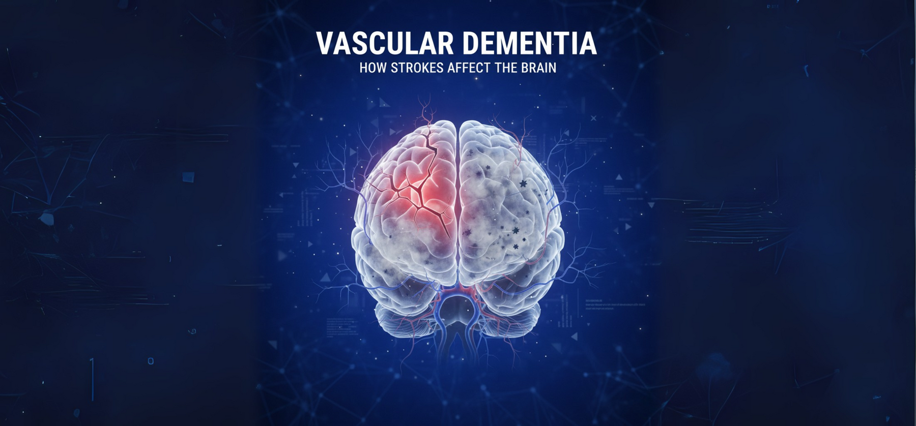 How Strokes Affect the Brain: A Look at Vascular Dementia